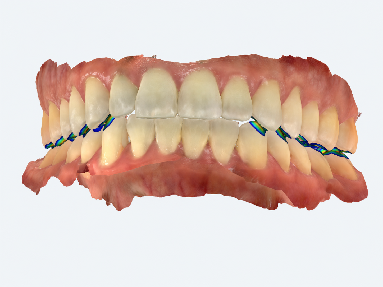 Advanced digital dental scan used for treatment planning