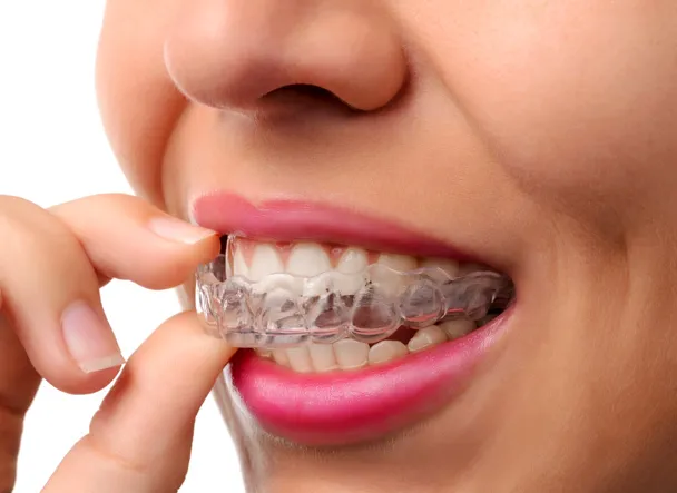 Invisalign clear aligners